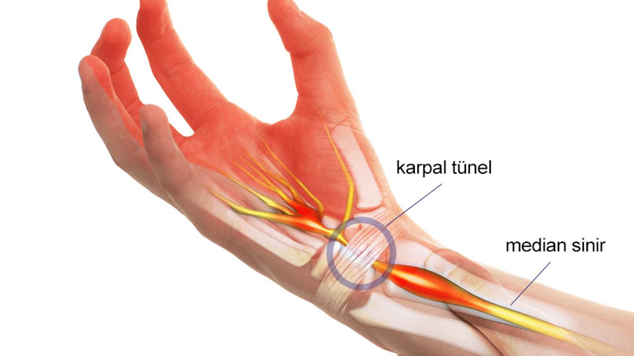 Karpal tünel sendromu nedir, neden olur? Karpal tünel sendromu belirtileri ve tedavisi…