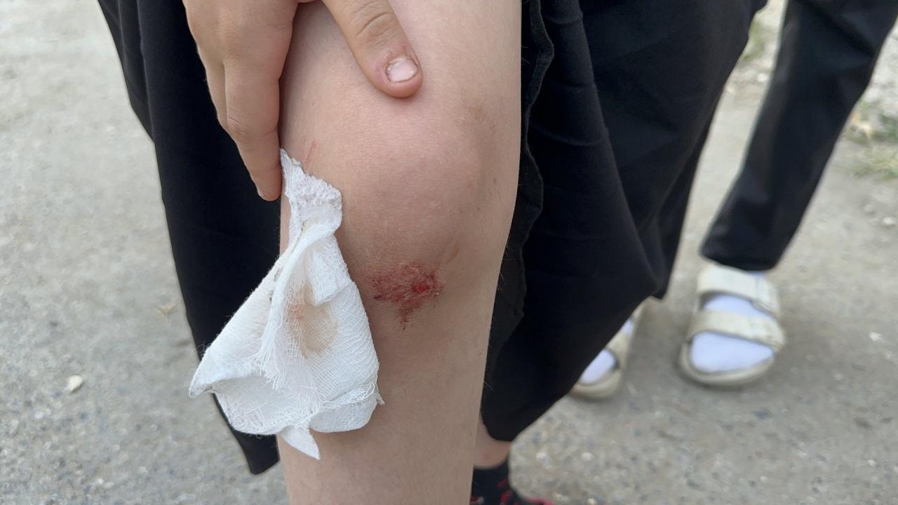 Sakarya'da 11 yaşındaki kız çocuğu sokak köpeğinin saldırısına uğradı