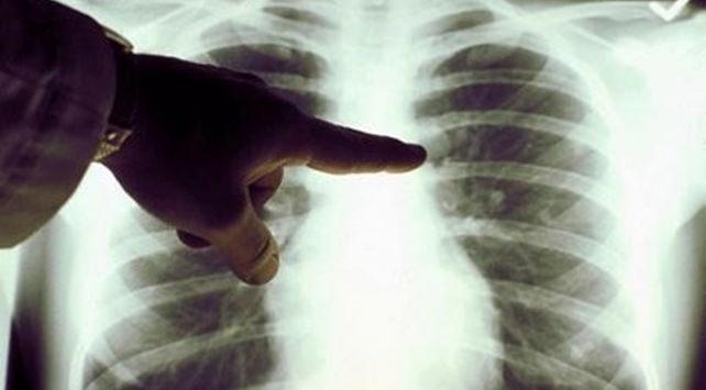 Dünyada en çok ölüme neden olan kanser: Akciğer kanseri