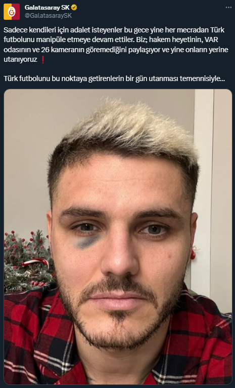 Maçta direğe çarpan Icardi'nin elmacık kemiği kırıldı