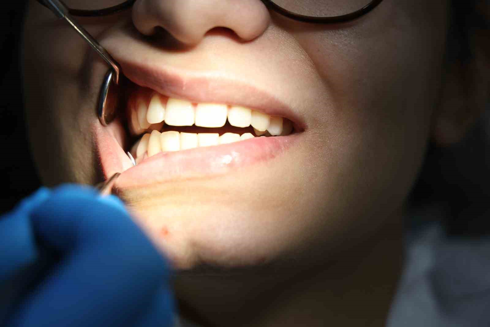Diş hekimi Yüksel: ’’Diş gıcırdatmanın yüzde 90’ı strese bağlı olarak ortaya çıkıyor’’