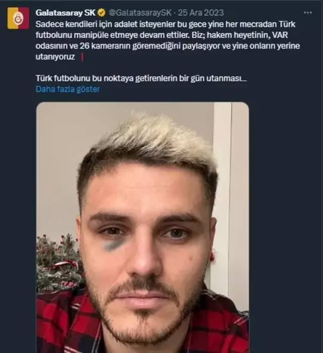 Galatasaray'da Mauro Icardi depremi! Bir süre yeşil sahalardan uzak kalacak