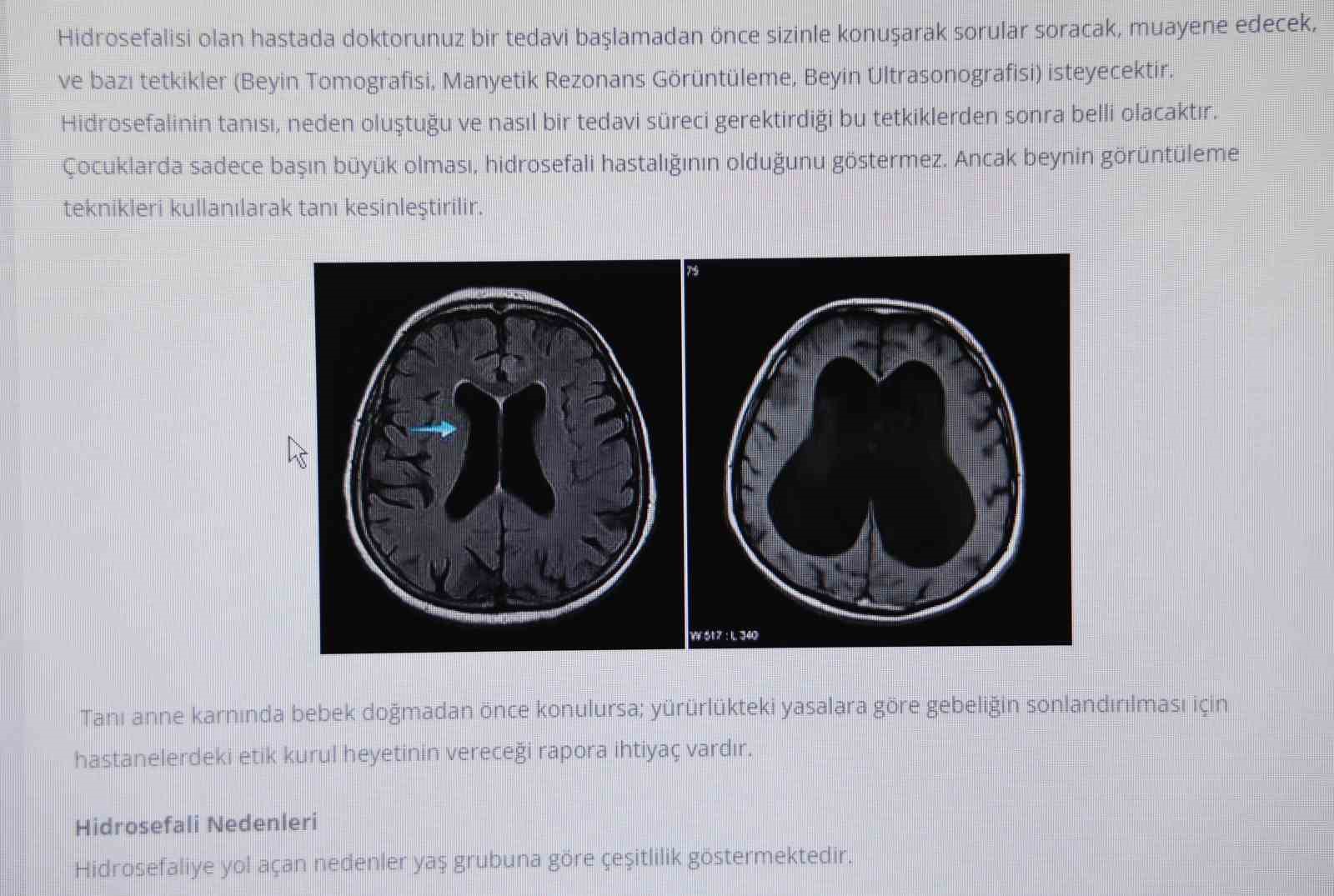 Beyin Cerrahı Uzmanı Op. Dr. Koparan: ’’Hidrosefali, erken teşhis konulmazsa ölüme sebebiyet verebilir’’