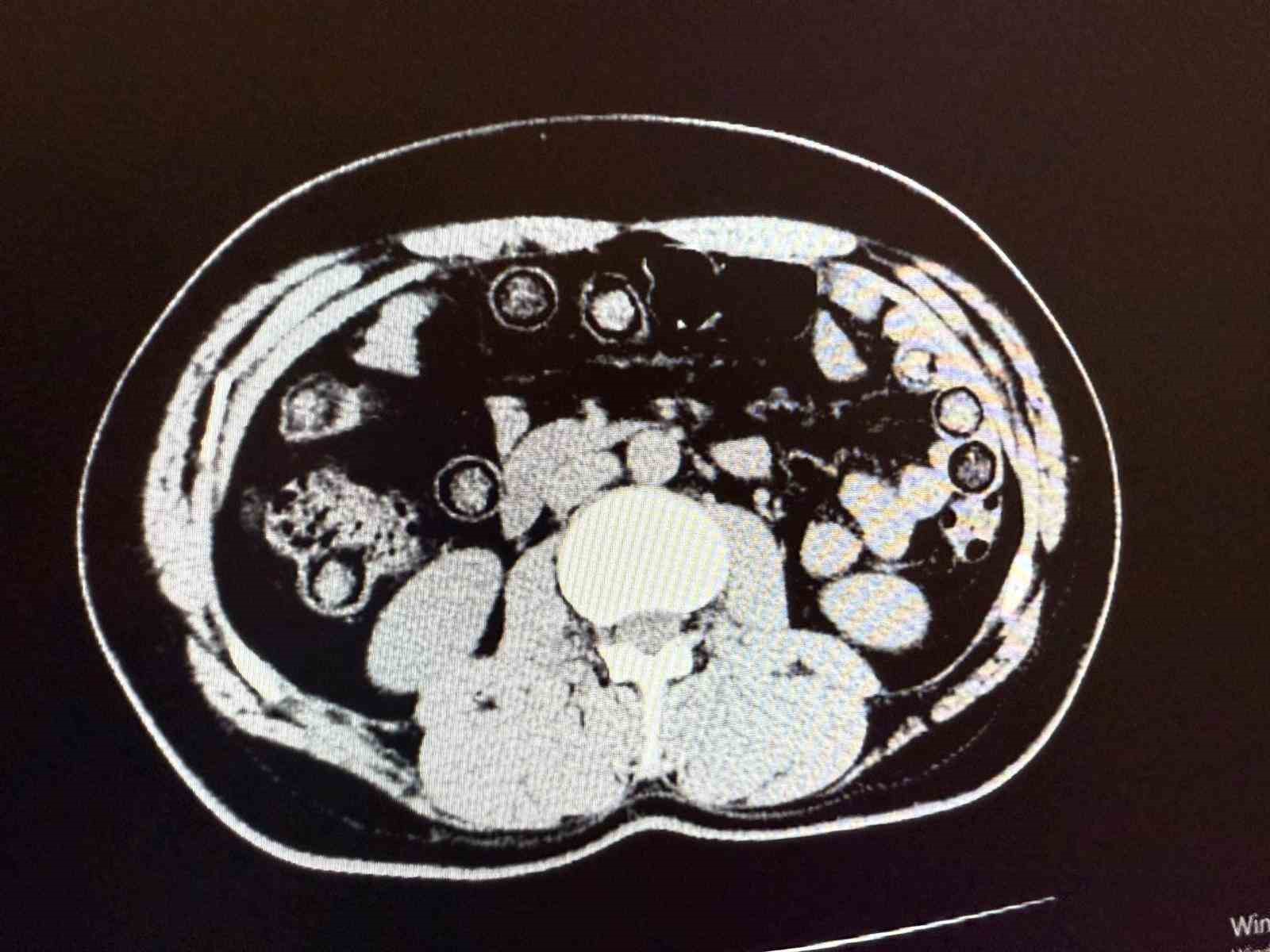 Muş’ta midelerinden 928 gram uyuşturucu çıkan 2 İranlı tutuklandı